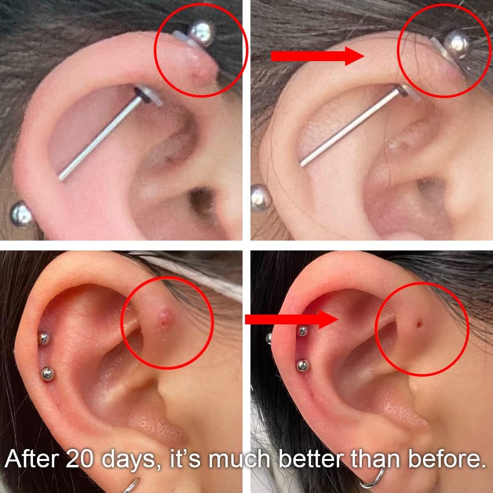 How to get rid of a piercing bump